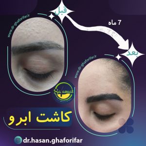 کاشت ابرو در ارومیه